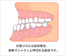 3歳児からの受け口治療